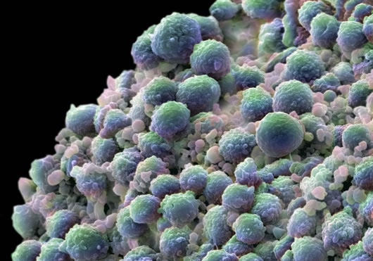 A clump of prostate cancer cells